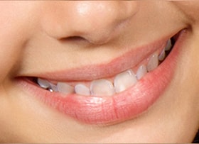 After - Single Molar Implant