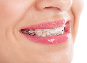 After - Ceramic Veneers