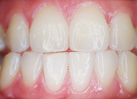 Before - Invisalign Correction