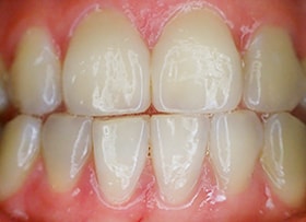 After - Invisalign Correction