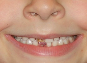 After - Laser Whitening